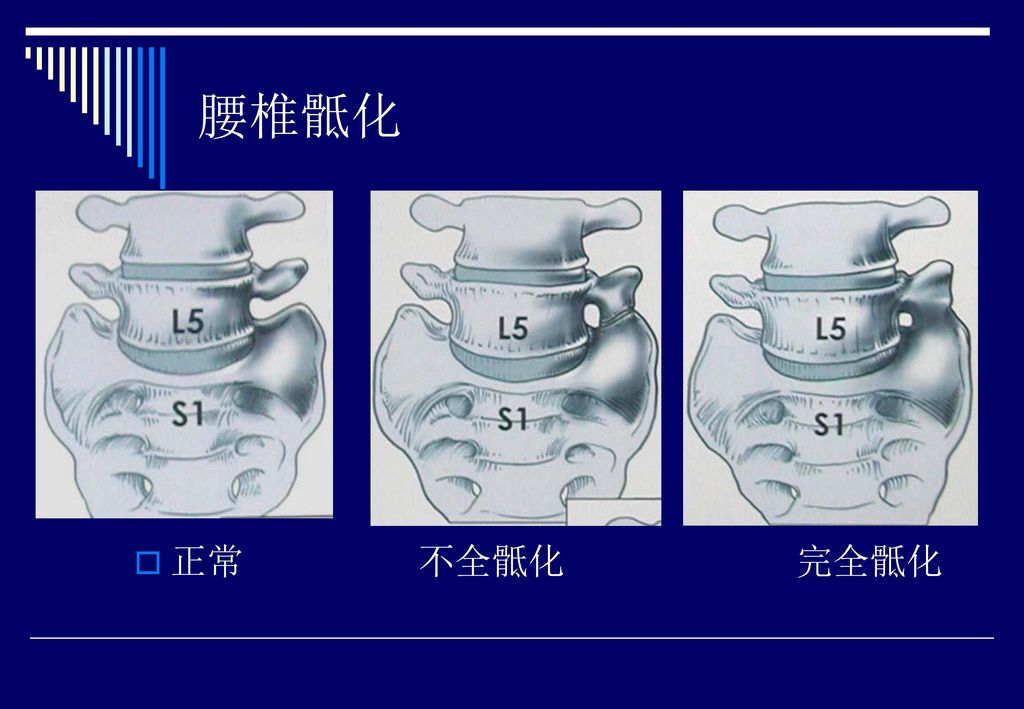 特发性脊柱侧弯 adolescence idiopathic scoliosis